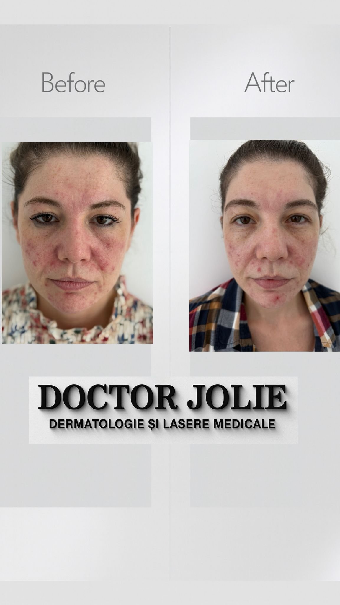 Rezultat tratament acnee Doctor Jolie Alba Iulia