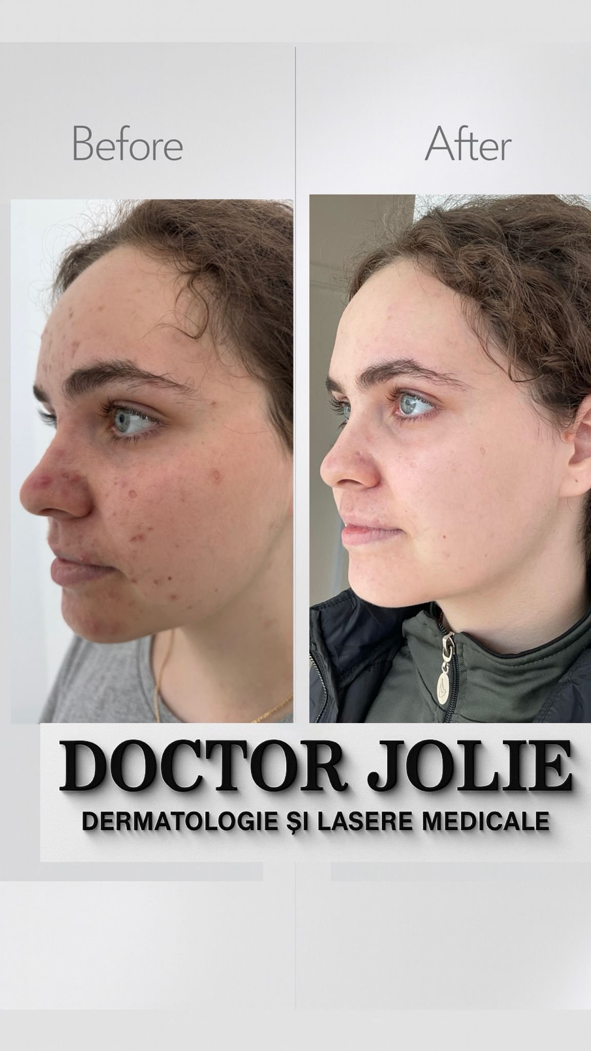 Rezultat tratament acnee Doctor Jolie Alba Iulia