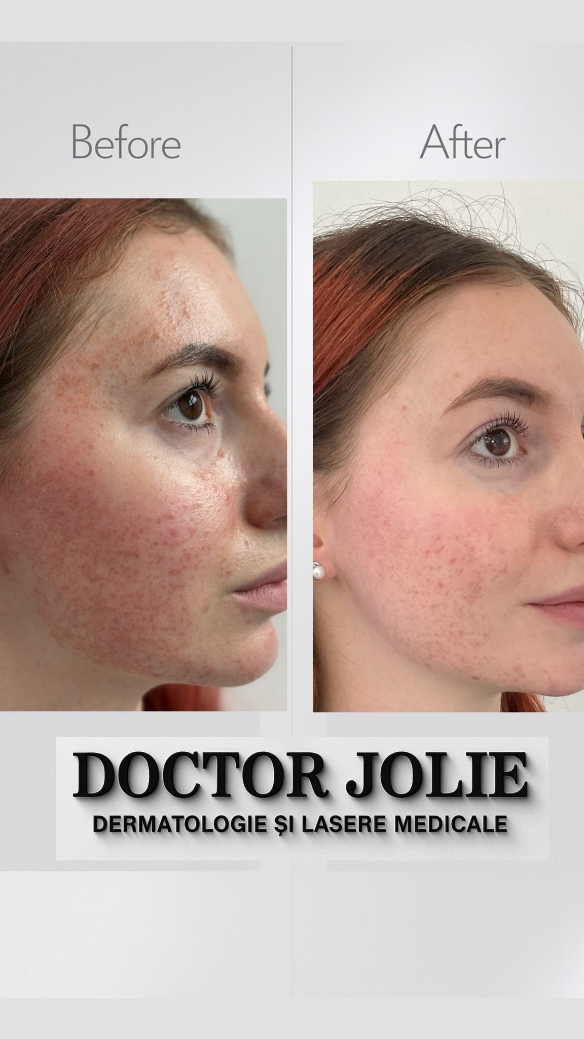 Rezultat tratament acnee Doctor Jolie Alba Iulia