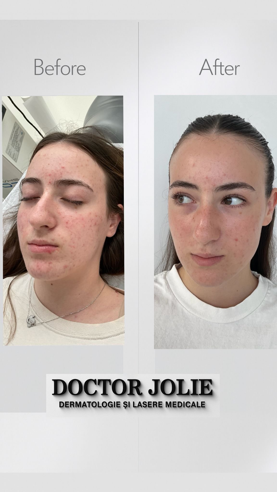 Rezultat tratament acnee Doctor Jolie Alba Iulia