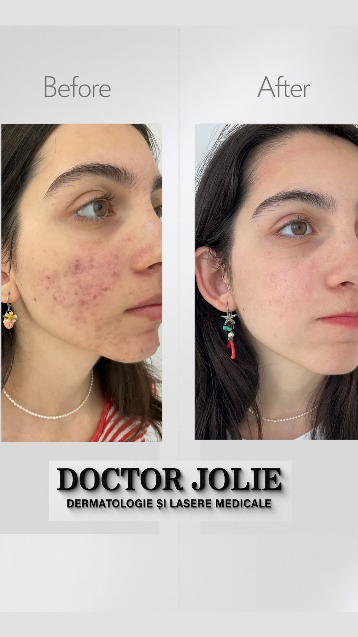 Rezultat tratament acnee Doctor Jolie Alba Iulia
