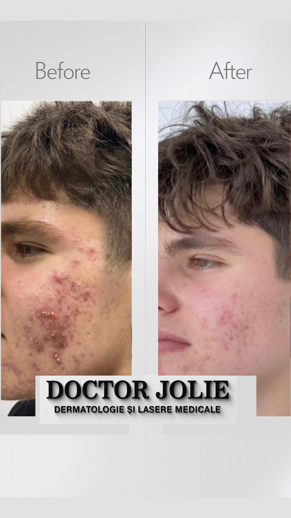 Rezultat tratament acnee Doctor Jolie Alba Iulia